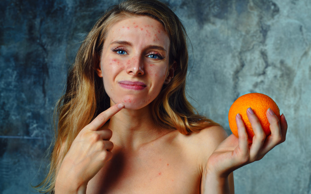 Allergie alimentari. I consigli della nutrizionista